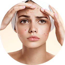 Acne treatment Singapore