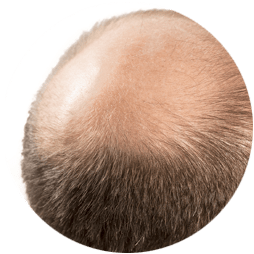 Male & Female Pattern Hair Loss