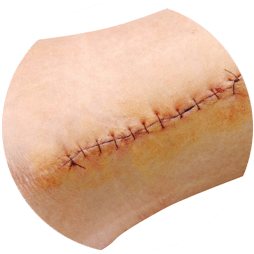 Surgical Wound Revision