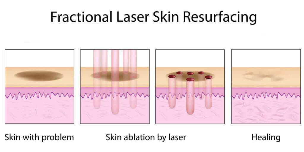 Fractional co2 laser skin resurfacing