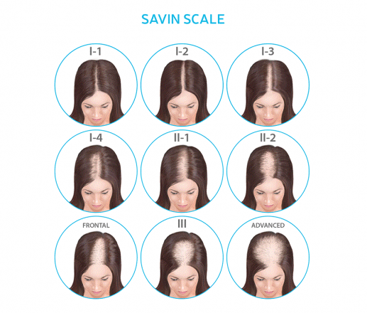 stages of female pattern hairloss