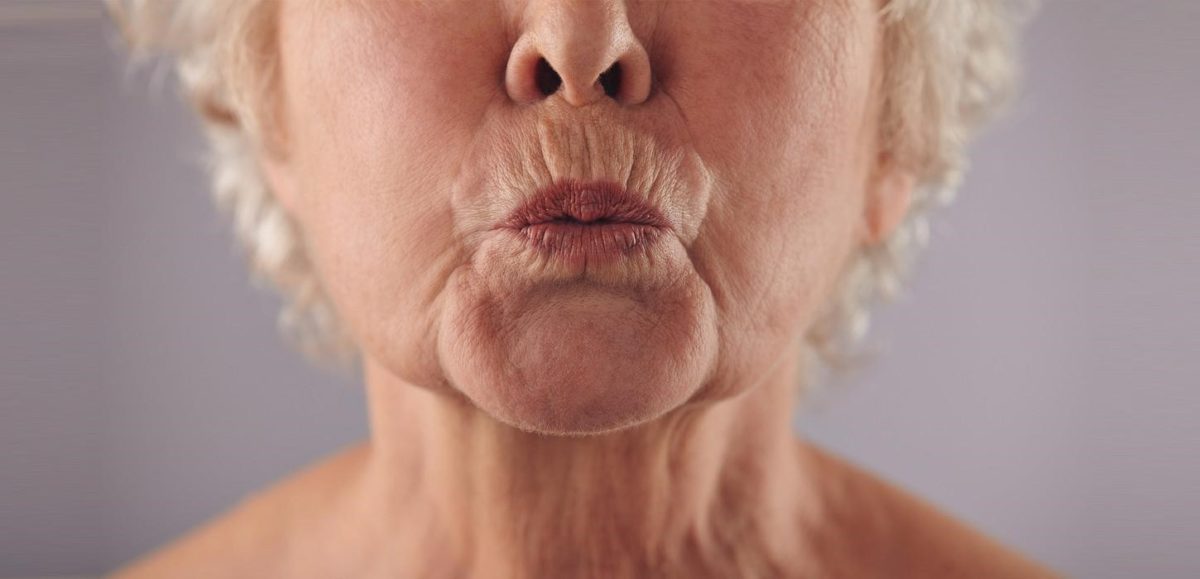 Kiss Goodbye To Upper Lip & Smoker’s Lines With Botox