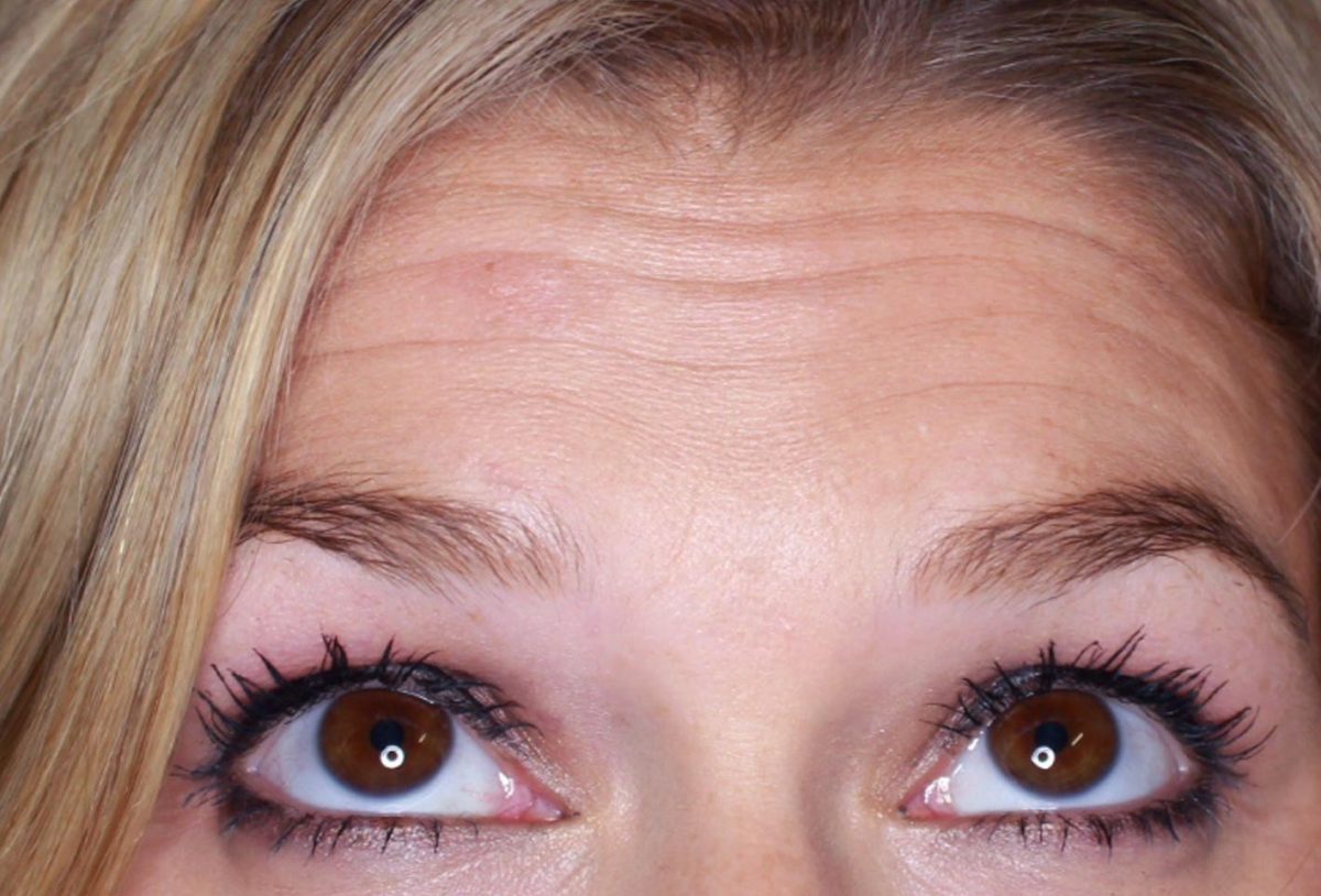 horizontal forehead lines